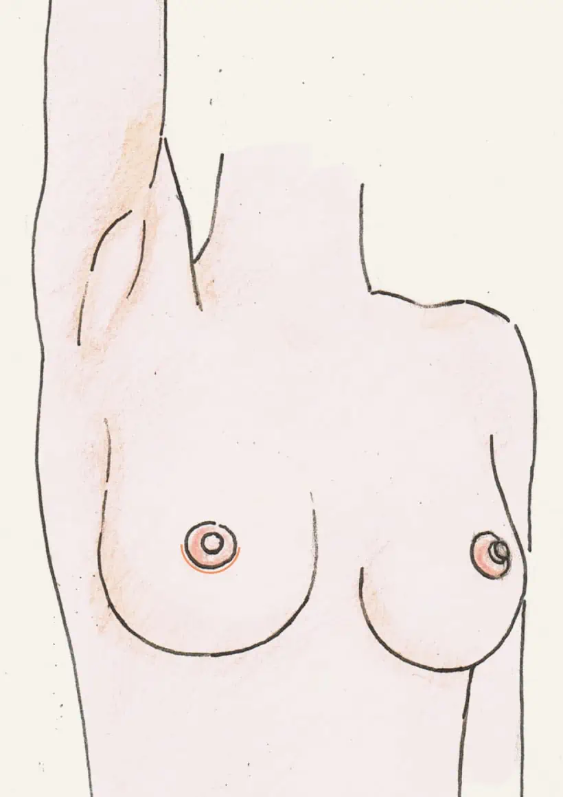 Brustvergrößerung Eigenfett