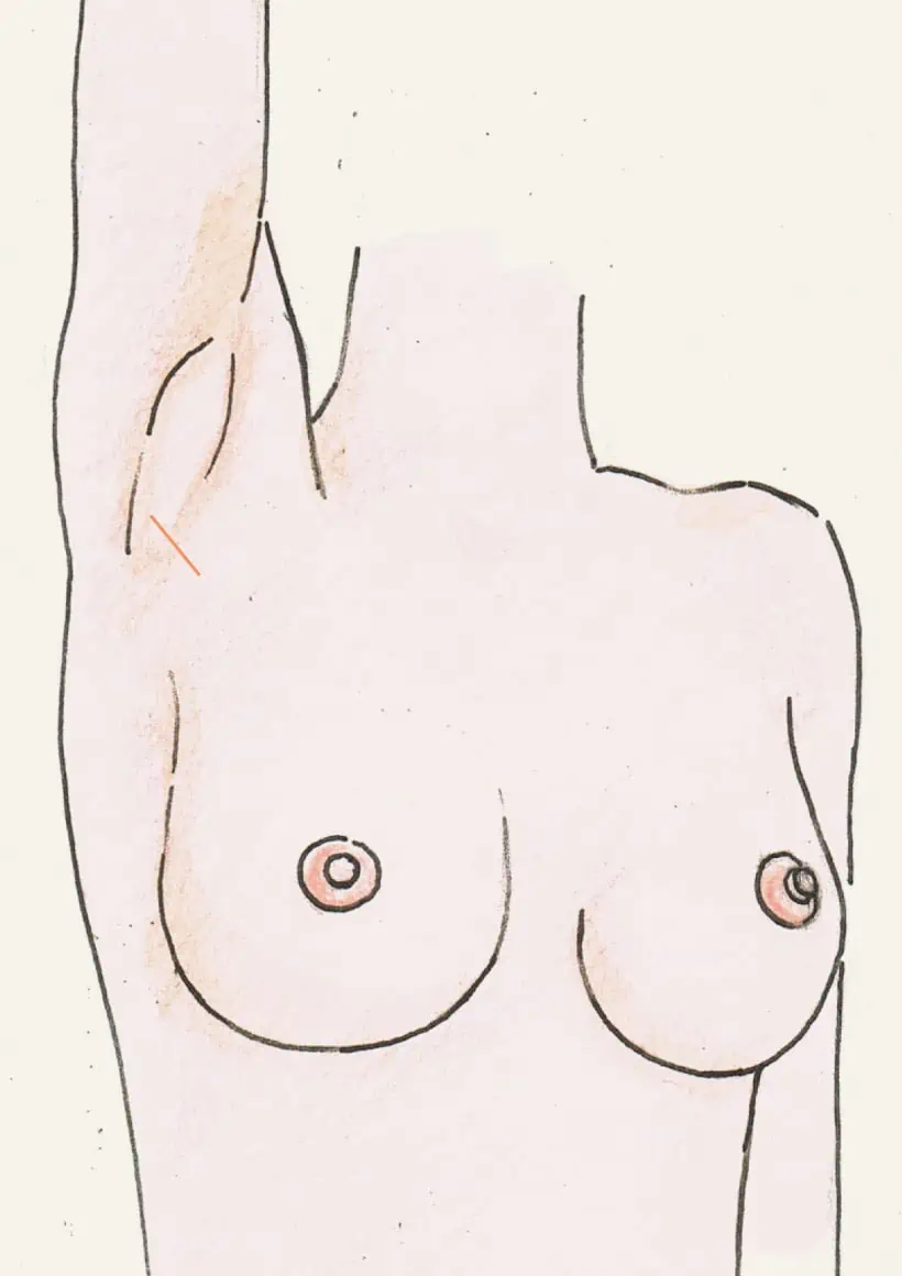 Brustvergrößerung